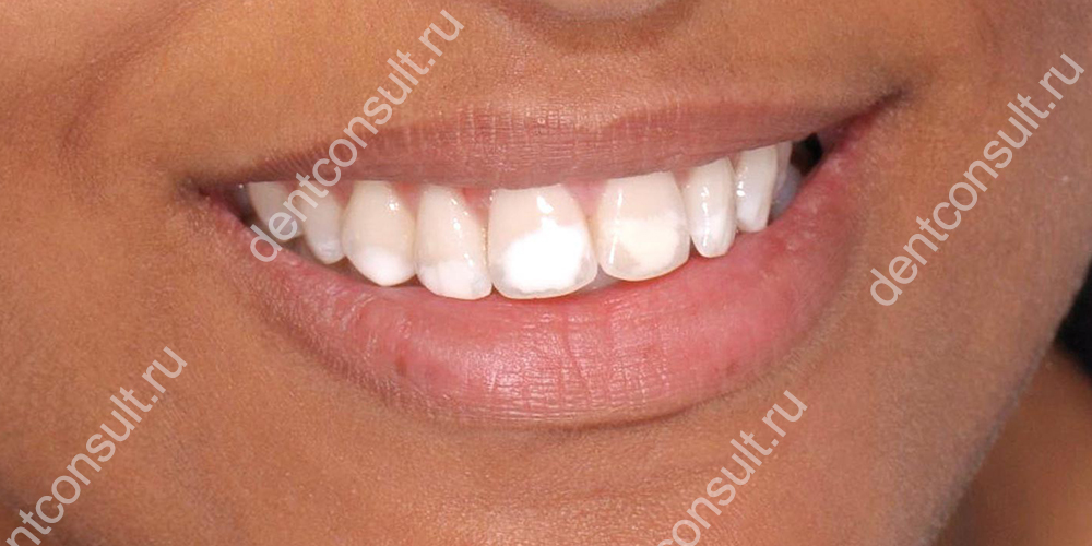 флюороз – пресыщение организма фтором, которое проявляется в виде белых пятен на зубах и хрупкости эмали.