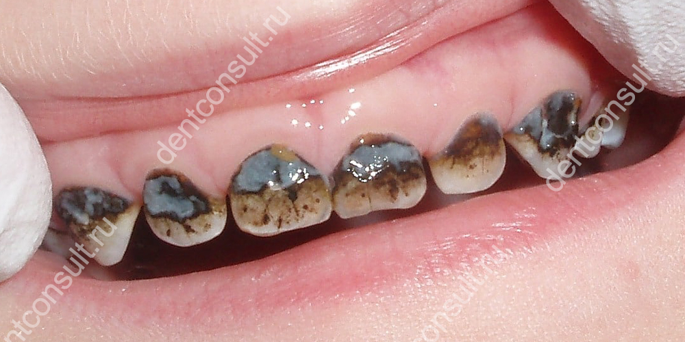 Глубокое фторирование не красит зубы в черный или серый цвет, как это получается при серебрении
