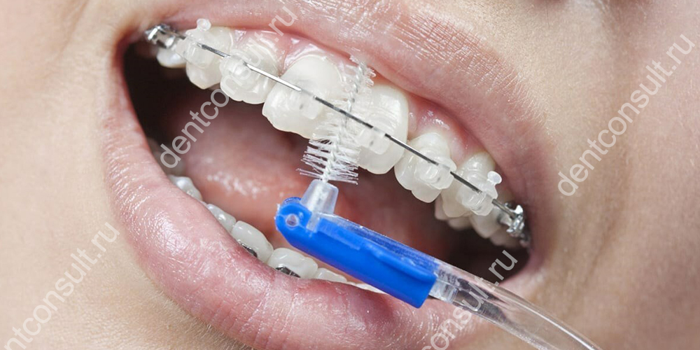 Если небрежно относиться к чистке зубов с брекетами то наросты налета и камня провоцируют деминерализацию эмали под ними