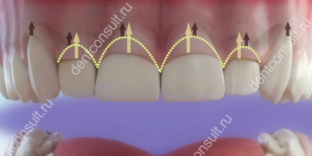 Удлинение зубов – зачем нужно