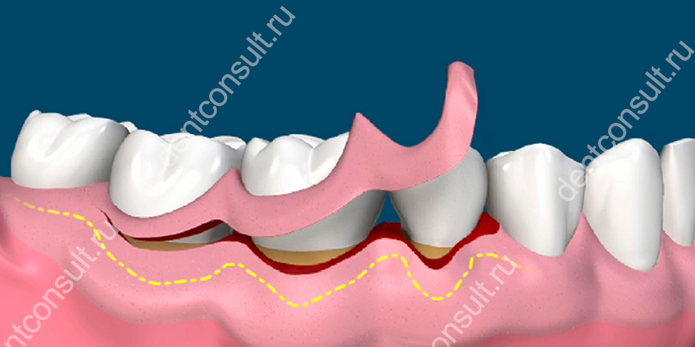 Хирургическое удлинение зуба заключается в том, что стоматолог-хирург подрезает массивную десну.