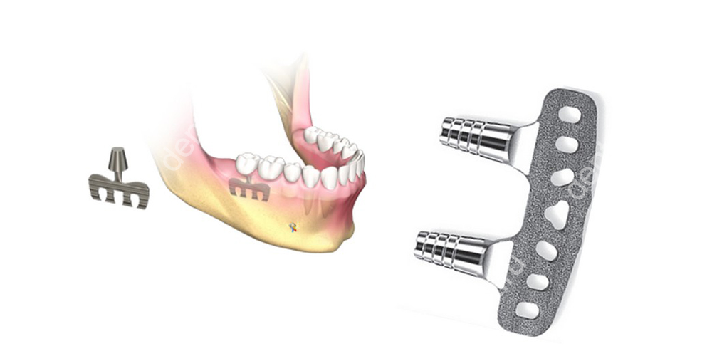 Пластинчатые или пластиночные имплантаты зубов – это металлические импланты особой формы