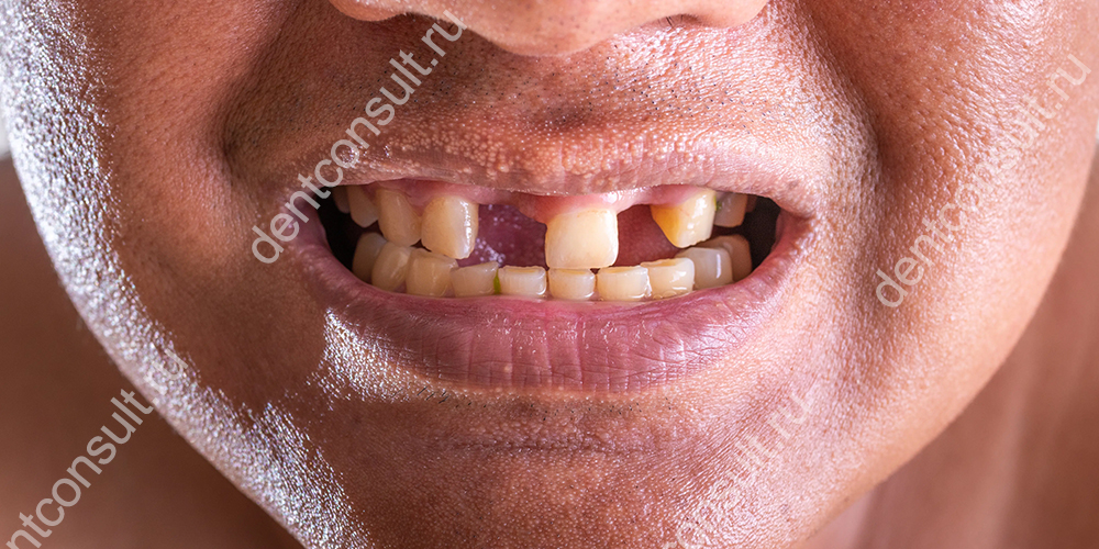 Нарушение целостности зубных рядов приводит к нескольким проблемам – портит улыбку и здоровье