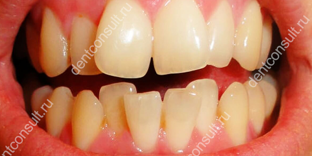 Зубы, которые расположены по бокам от дефекта (пустого места), теряют боковую поддержку