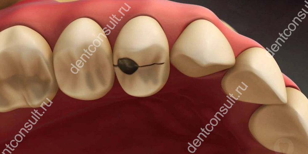 Травмирование зубов при лечении может быть как нормальным, так и патологическим.