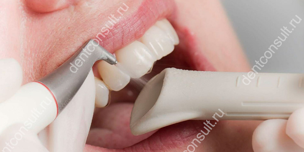 Air-Flow, безопасен как для протезов на имплантах, так и для собственных зубов,
