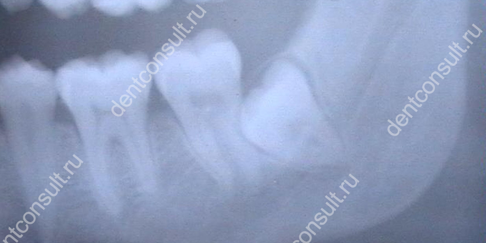 Перикоронит зуба чаще всего появляется из-за недостатка места на зубном ряду.