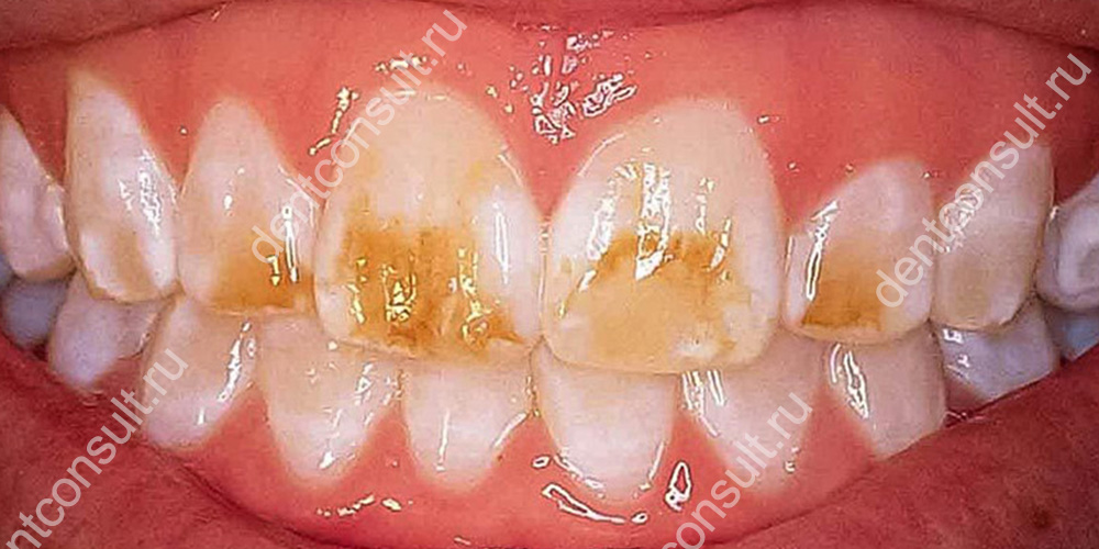 Все заболевания эмали зубов можно разделить на 2 вида – кариозные (кариес) и некариозные.