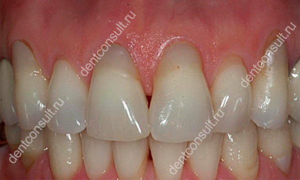 При использовании вейпа у подавляющего числа людей убывают десны вокруг зубов