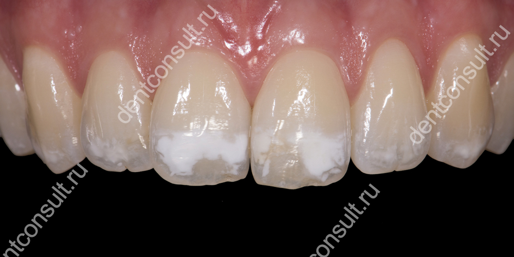 При начальной форме кариеса,  на зубе образуется белое или меловое пятно