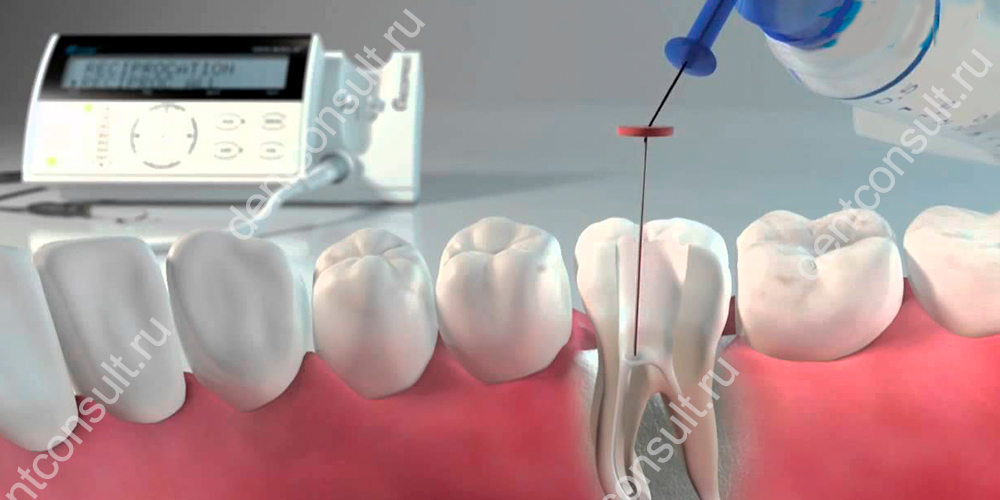 ирригация и дезинфекция каналов зуба жидкостями
