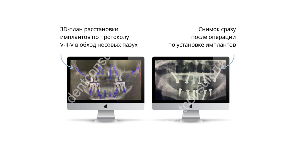 От цифрового планирования установки имплантов с помощью V-II-V (слева) до результата (справа). Изображение предоставлено стоматологией Smile-at-Once.
