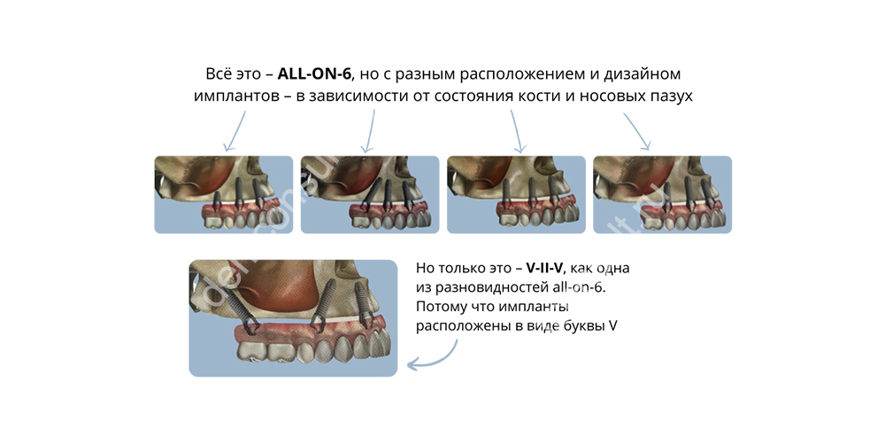 Разные методики размещения имплантов при All-on-6. Но к V-II-V является только нижний, где боковые имплантаты стоят в виде символа V. Изображение предоставлено стоматологией Smile-at-Once.