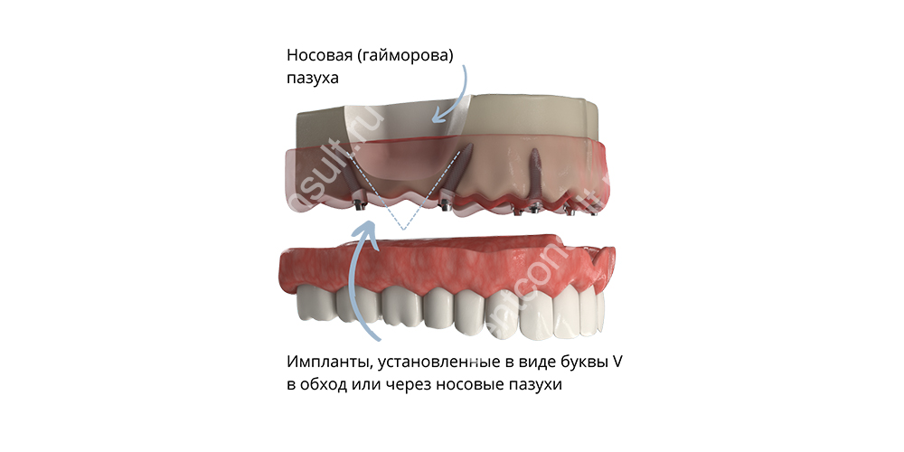 Боковые имплантаты ставят в виде галочки или знака «V». Справа и слева они огибают гайморову пазуху, расположенную над верхней челюстью. Фото предоставлено стоматологией Smile-at-Once.