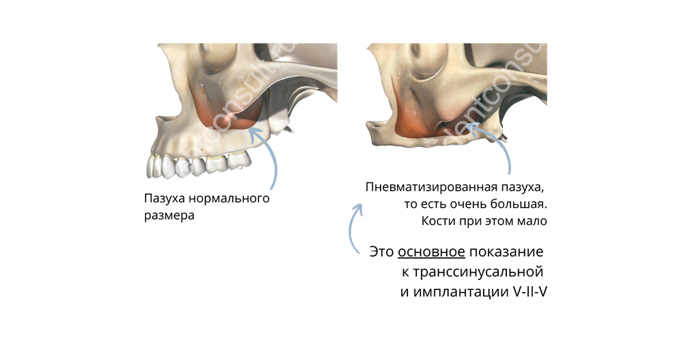Нехватка кости в зоне по бокам верхней челюсти и пневматизированные гайморовы пазухи – основные показания к имплантации V-II-V. Изображение предоставлено стоматологией Smile-at-Once.