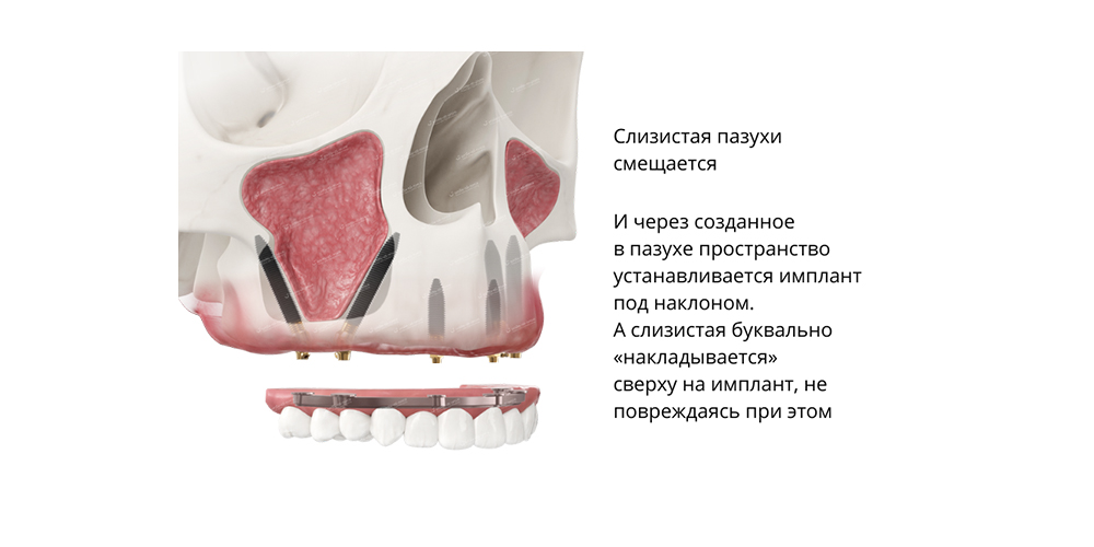 Один из возможных вариантов установки имплантов транссинусально. Фото предоставлено стоматологией Smile-at-Once.