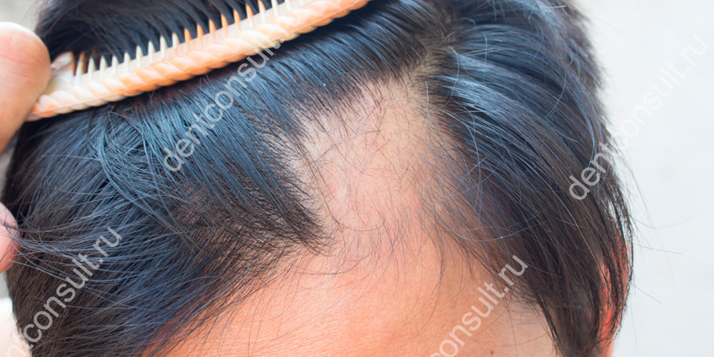 У людей с болезнями десен выпадают волосы чаще чем у других