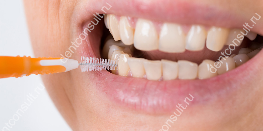 Что представляют собой и для чего нужны ершики для зубов?